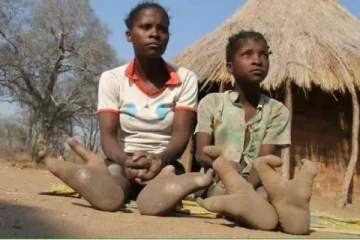 மொத்த கிராமத்திற்கும் இப்படியொரு கால்களா? தீக்கோழி மனிதர்கள் - திகைக்க வைக்கும் தகவல்!