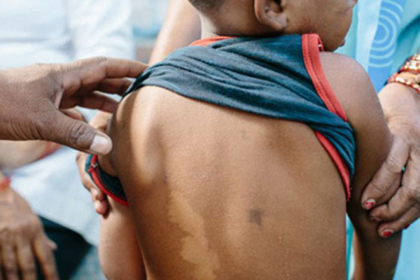 இலங்கையில் சிறுவர்களை தாக்கும் தொழு நோய்! | Leprosy Attacks Children In Sri Lanka