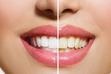 உங்கள் பற்கள் மஞ்சளாக உள்ளதா? இதனை போக்க சூப்பர் டிப்ஸ் இதோ!