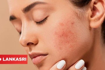 முகப்பருவால் ஏற்பட்ட தழும்புகளை எளியமுறையில் போக்கனுமா? இதோ அசத்தலான டிப்ஸ்!