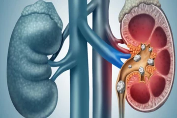 சிறுநீரக கற்களால் அவதிப்படுகிறீர்களா? இந்த உணவுகளை கட்டாயம் எடுத்துக்கோங்க