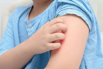 குழந்தைகளை தாக்கும் தக்காளி காய்ச்சல்