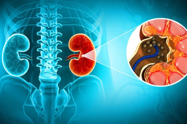 தக்காளி சாப்பிட்டால் சிறுநீரக கற்கள் உருவாகுமா? | Tomatoes Kidney Stones Life Style Health