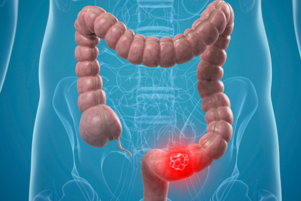 குடல் புற்றுநோயை எச்சரிக்கும் 5 முக்கிய அறிகுறிகள்.., என்னென்ன தெரியுமா? | 5 Main Warning Signs Of Bowel Cancer In Tamil குடல் புற்றுநோயை எச்சரிக்கும் 5 முக்கிய அறிகுறிகள்.., என்னென்ன தெரியுமா? | 5 Main Warning Signs Of Bowel Cancer In Tamil