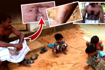 உடலில் பதினாறு இடங்களில் எறிகணையின் துகள்களை தாங்கியவாறு வாழும் தந்தையின் அவல நிலை!