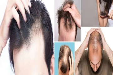 அட இது தெரியாமல் போச்சே! வழுக்கை விழுவதற்கு இததெல்லாம் காரணமா?