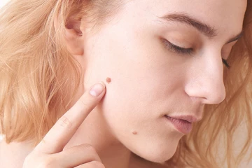 முகத்தை அசிங்கமாக காட்டும் மருக்களை நீக்க வேண்டுமா?