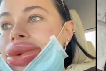 உதடுகள் வீங்கிய மாடல் அழகியின் பரிதாப நிலை!