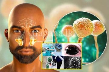 මෙරට කලු දිලීර රෝගීන්ගේ වර්ධනයක්. - රෝගයේ භයානකකම ගැන දැනුම්දීමක්.