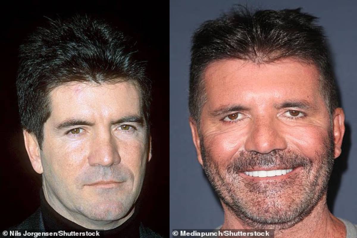 அழகியல் அறுவை சிகிச்சைக்குப் பின் ஆளே மாறிப்போன நடிகை | Famous Actors Now Look Different After Surgery அழகியல் அறுவை சிகிச்சைக்குப் பின் ஆளே மாறிப்போன நடிகை | Famous Actors Now Look Different After Surgery
