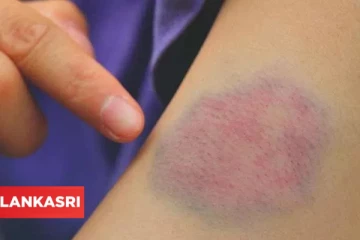 ரத்த கட்டை எளிதில் குணமாக வேண்டுமா? இதோ சில இயற்கை வைத்திய முறைகள் !!