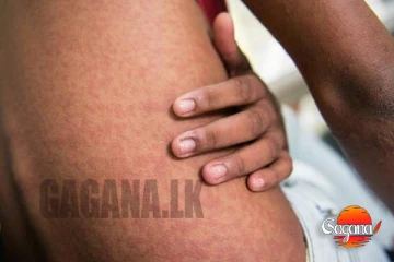 රෝගය ව්‍යාප්තවෙයි – පැතිරෙන ප්‍රදේශ හඳුනාගැනීම අපහසුයි