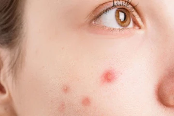 முகப்பருக்கள் நீங்க ஒரு இரவு போதும்... இத மட்டும் ட்ரை பண்ணி பாருங்க!