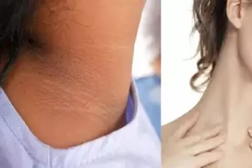 உங்களுக்கு கழுத்தில் கருமை இருக்குதா? அப்படியென்றால் இதை செய்து பாருங்கள்