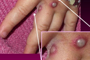 සීග්‍රයෙන් පැතිර යන මංකිපොක්ස් හඳුනාගැනීමේ මාර්ගෝපදේශ නිකුත් කෙරේ