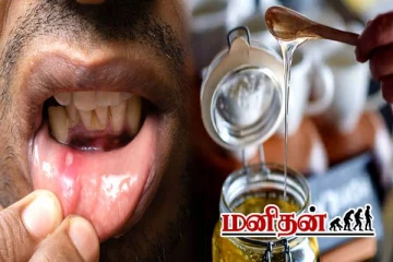 அடிக்கடி வாய்ப்புண் வருதா? ஒரே தடவையில் ஆற்றும் மருந்து உங்க வீட்டு சமையல் இருக்கே