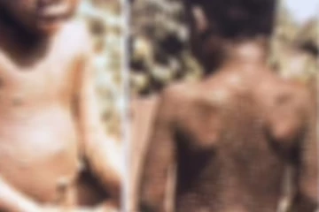 பிரித்தானியாவில் மேலும் இருவருக்கு குரங்கம்மைத் தொற்று கண்டுபிடிப்பு