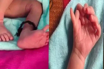 26 விரல்களுடன் பிறந்த அதிசய குழந்தை