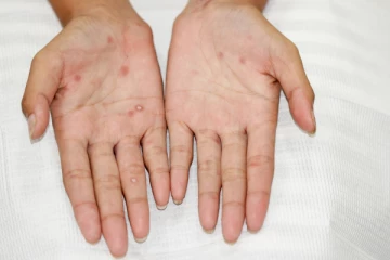 கனடாவில் பால்வினை நோய் தொடர்பில் எச்சரிக்கை