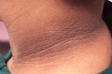 உங்களுக்கு கழுத்து மட்டும் கருப்பா அசிங்கமா இருக்கா? இதனை எப்படி போக்கலாம்?