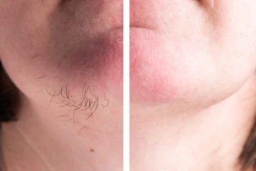 முகத்தில் உள்ள தேவையற்ற முடியை நீக்கும் 2 பொருட்கள் - எப்படி தெரியுமா?