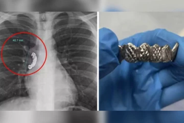 வெள்ளி பற்கள் விழுங்கிய இளைஞனின் உயிரை காப்பாற்றிய மருத்துவர்கள்!