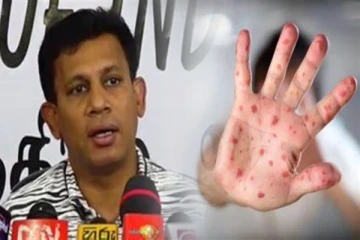மீண்டும் தலைதூக்கும் தட்டம்மை நோய் : சுகாதார அமைச்சு விடுத்துள்ள எச்சரிக்கை