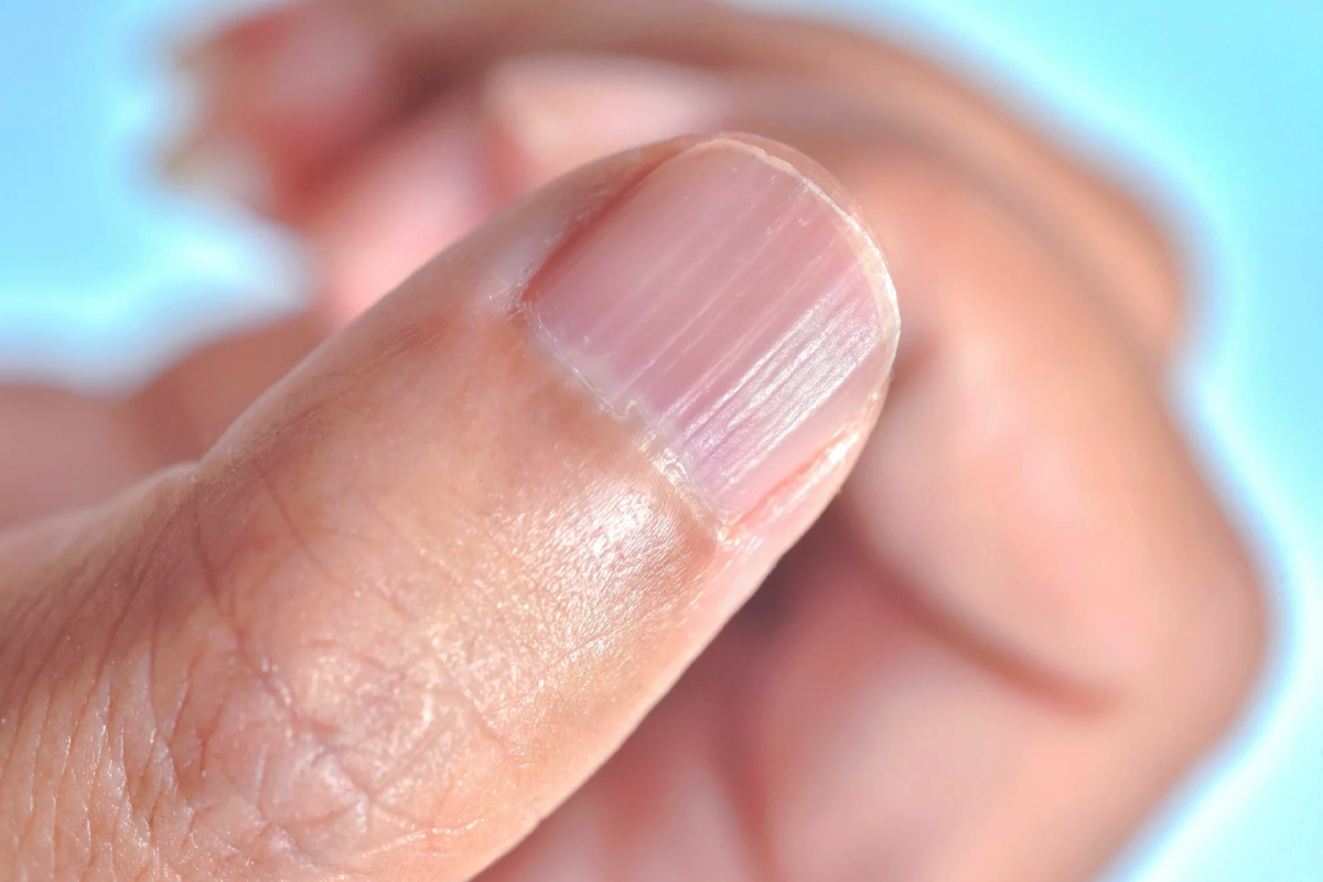 நகங்களில் நேரான புடைப்பான கோடுகள் இருக்கிறதா?இது வருவதன் காரணம் என்ன? | What Causes Straight Raised Lines On Nails