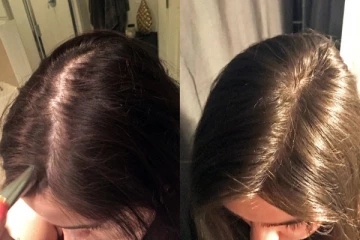 சொட்டை விழுந்த இடத்தில் வெந்தயத்தை இப்படி யூஸ் பண்ணுன்னா முடி கிடுகிடுன்னு அடர்த்தியா வளருமாம்!