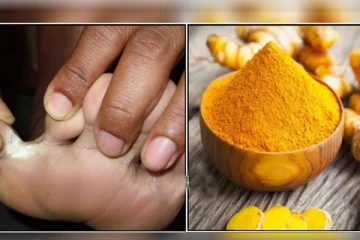 சேற்றுப்புண் பிரச்சினைக்கு மஞ்சள் மட்டும் போதும்! இப்படி பயன்படுத்தி பாருங்க