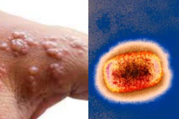 காற்று மூலம் பரவுகிறதா குரங்கு அம்மை - WHO எச்சரிக்கை! | Monkeypox Cases Reported To Who