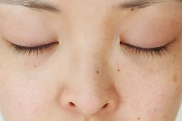 முகத்தில் அதிகமாக மச்சம்  இருக்கா? இதனை எளிய வழியில் போக்க இதோ சில டிப்ஸ்!