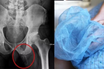 63 வயது ஆணின் பிறப்புறுப்பில் வளர்ந்த எலும்பு: பாதிக்கப்பட்ட நபர் எடுத்துள்ள முடிவு