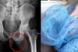 63 வயது ஆணின் பிறப்புறுப்பில் வளர்ந்த எலும்பு: பாதிக்கப்பட்ட நபர் எடுத்துள்ள முடிவு