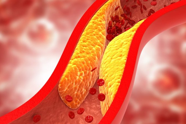 கொலஸ்ட்ராலால் மாரடைப்பு வராமல் இருக்க என்ன செய்ய வேண்டும் தெரியுமா ? | Know What Prevent Cholesterol Causing Heart Attack