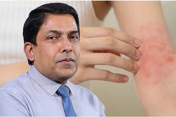 நாட்டில் வேகமாக பரவும் நோய் குறித்து விடுக்கப்பட்டுள்ள எச்சரிக்கை | Health Officials Warn Of Spreading Skin Infection