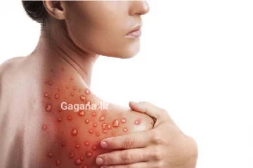 පරිස්සමෙන් මෙරට තුළ වේගයෙන් පැතිර යන මාරාන්තික රෝගයක් ගැන තොරතුරු රැසක් හෙළිවෙයි..