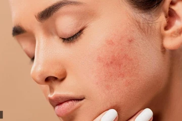 ஒரே நாளில் முகப்பருவை போக்கனுமா?  இதோ அட்டகாசமான டிப்ஸ்!