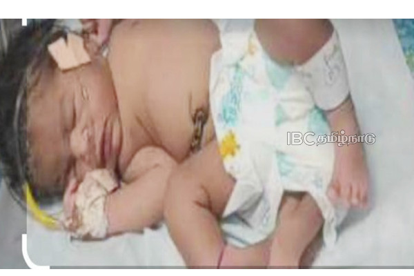 madhya-pradesh-birth-baby-girl-four-legs