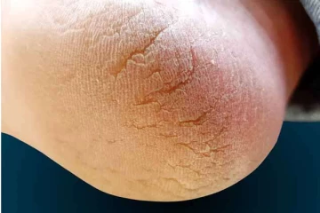 குதிகால் வெடிப்பை மின்னல் வேகத்தில் குறைக்க இந்த ஒரு பொருள் போதும்! உடனடி மருத்துவம்