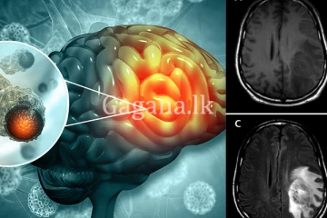 ගොඩක් අයට තියෙනවා - ඒත් නොසලකා හරින මේ මාරාන්තික රෝග ලක්ෂණ ගැන සැලකිලිමත් වන්න. (VIDEO)