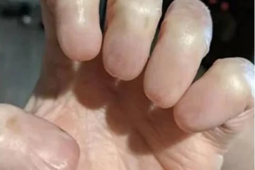 கை விரல்களில் நகங்கள் இல்லை! வைரலாகும் அதிர்ச்சி புகைப்படம்