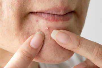 ஒரே நாளில் முகத்தில் உள்ள பருக்களை விரட்ட வேண்டுமா? இதோ சில எளிய வழிகள்