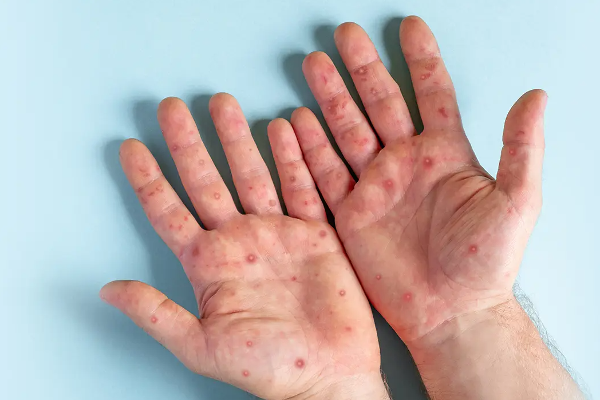குரங்கம்மை தொடர்பில் சுகாதார அமைச்சின் அறிவிப்பு | Notification Of Ministry Of Health Monkeypox