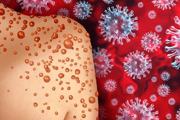 கேரளாவில் பரவியதா குரங்கு அம்மை ? வெளியான அதிர்ச்சி தகவல் - தமிழ்நாடு