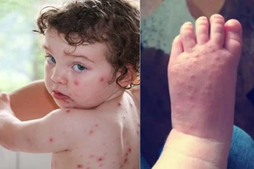 தக்காளி காய்ச்சல் வந்த உடனே என்ன செய்யவேண்டும்?