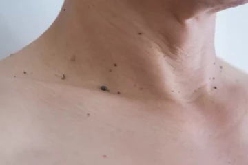 மருக்களை அடியோடு நீக்க வேண்டுமா? இதனை போக்க இதோ சில டிப்ஸ்