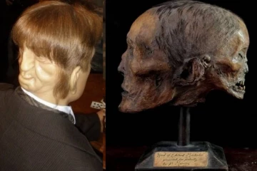 හිස පිටුපස භයානක මුහුණක් සමඟ ඉපදුනු මිනිසා. (PHOTOS)