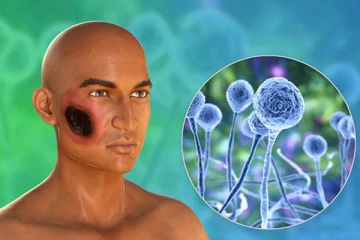 භයානක කළු පුස් රෝගය ගැන ඔබ දන්නවද?