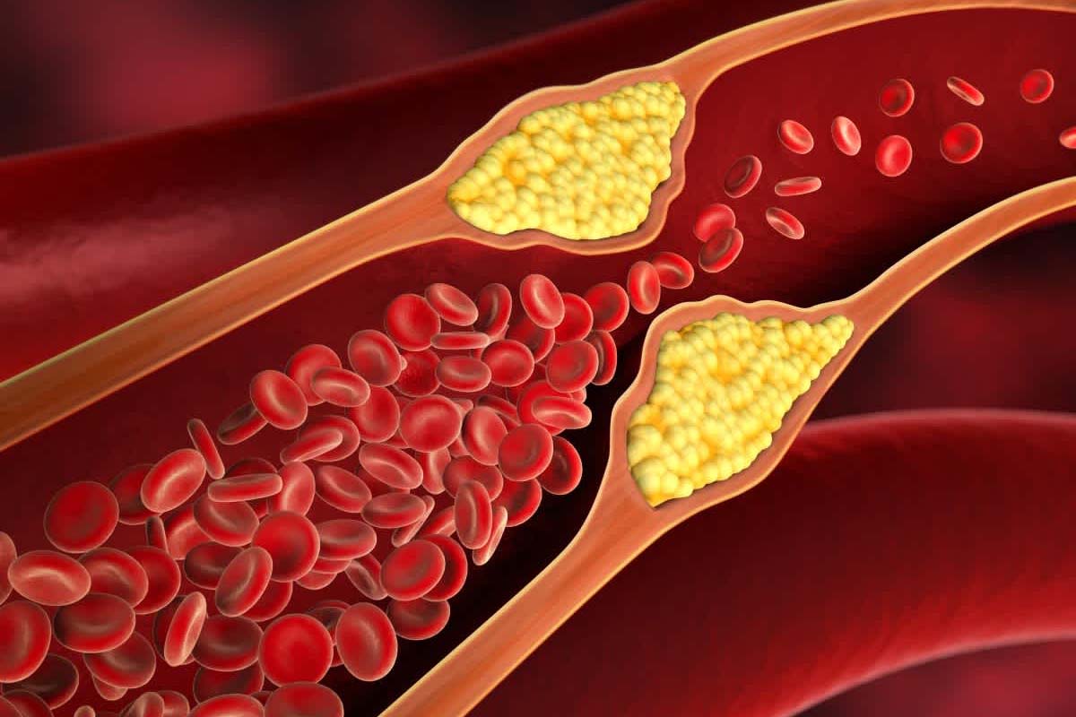 கெட்ட கொழுப்பினை அடித்து விரட்ட வேண்டுமா? பூண்டை இப்படி எடுத்துக்கோங்க | Garlic How To Help Cholesterol Control